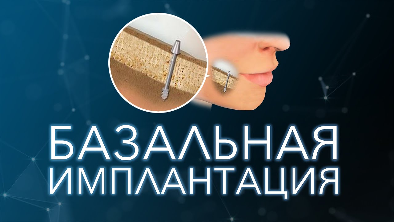 Базальная имплантация зубов.