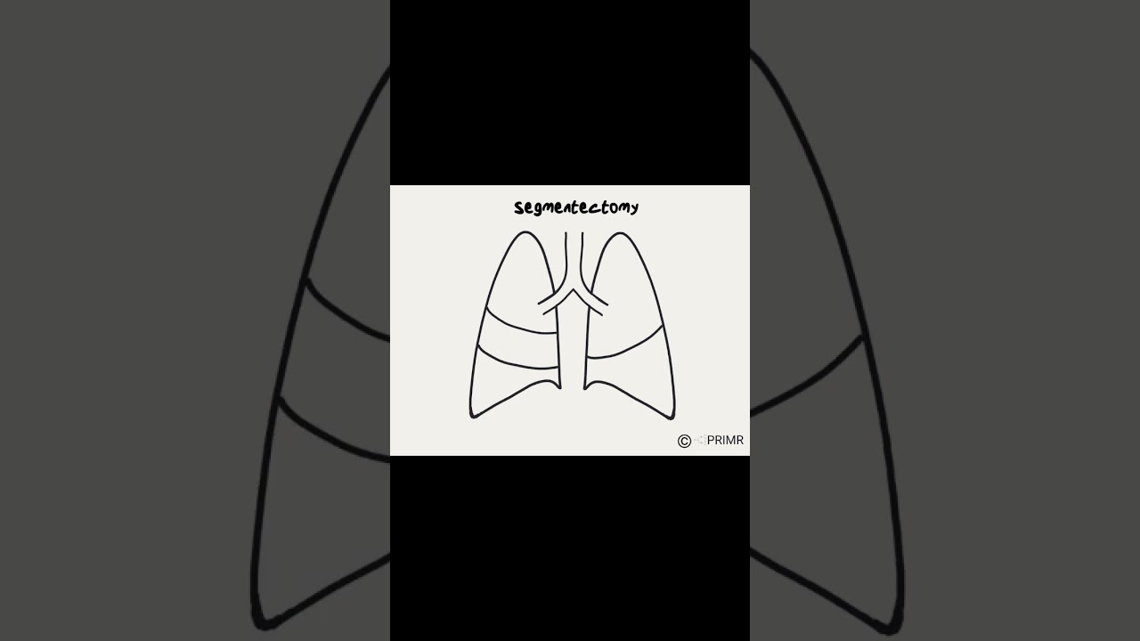 What are my lung cancer surgery options? 🫁