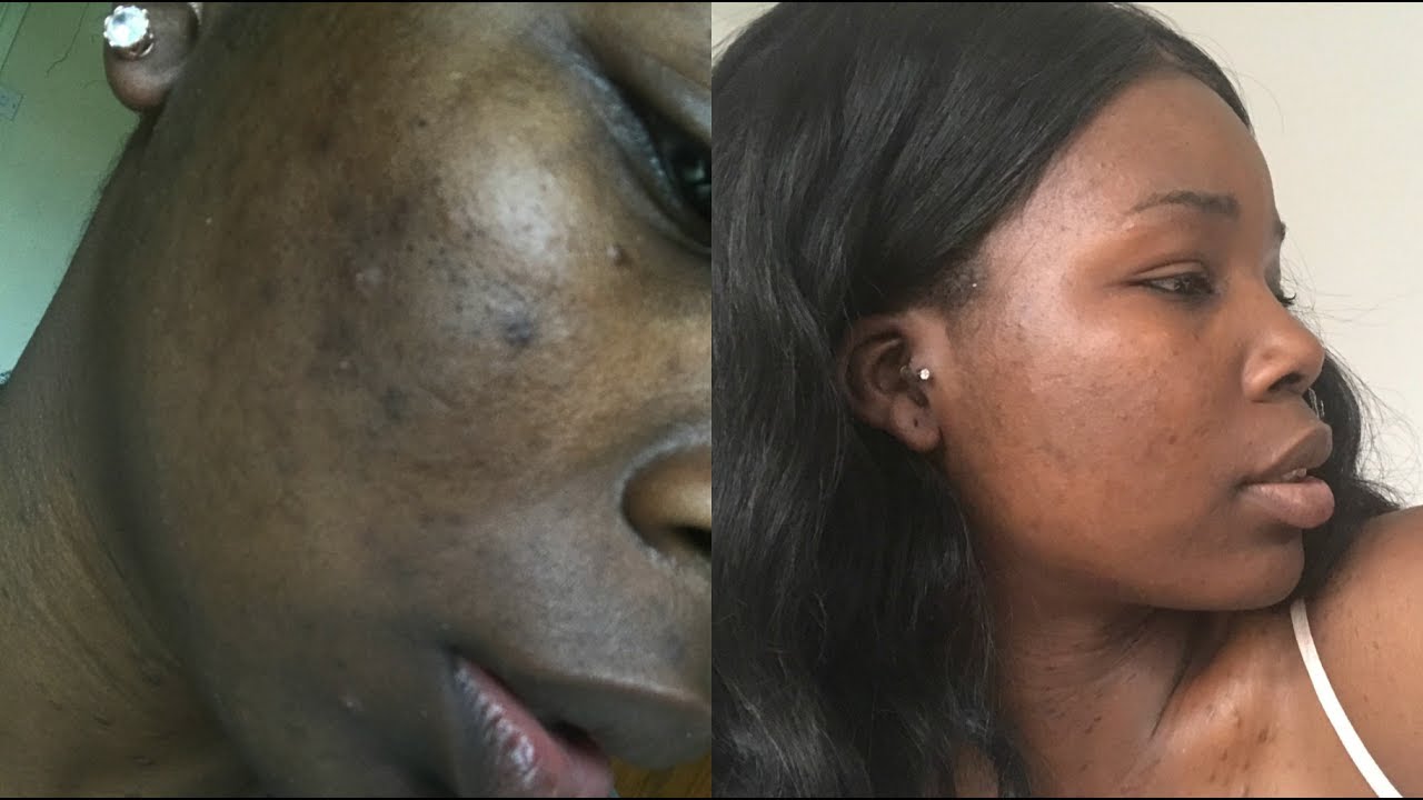 How I Got Rid Of MY Acne QUICK + FAST RESULTS | MsDebDeb