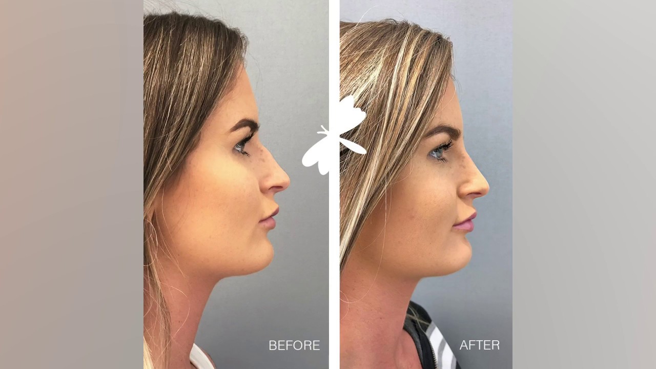 Non Surgical Nose Reshaping | The Laser and Skin Clinic