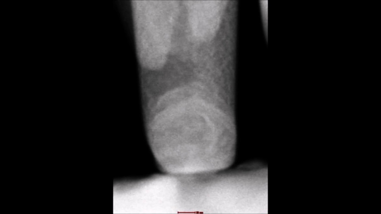 Dislocation Multiplications in Extremely Small Hexagonal-structured Titanium Nanopillars