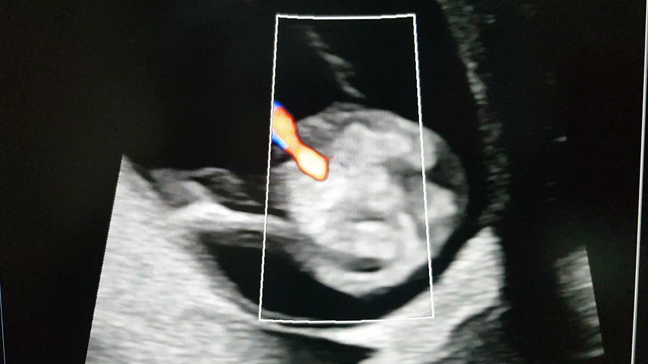 Single umbilical artery pitfalls in imaging - Dr Pradeep Srinivasan- REFER SERIES