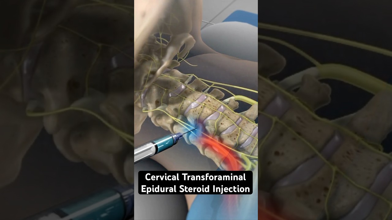 Using steroids to relieve neck pain (3D Animation)