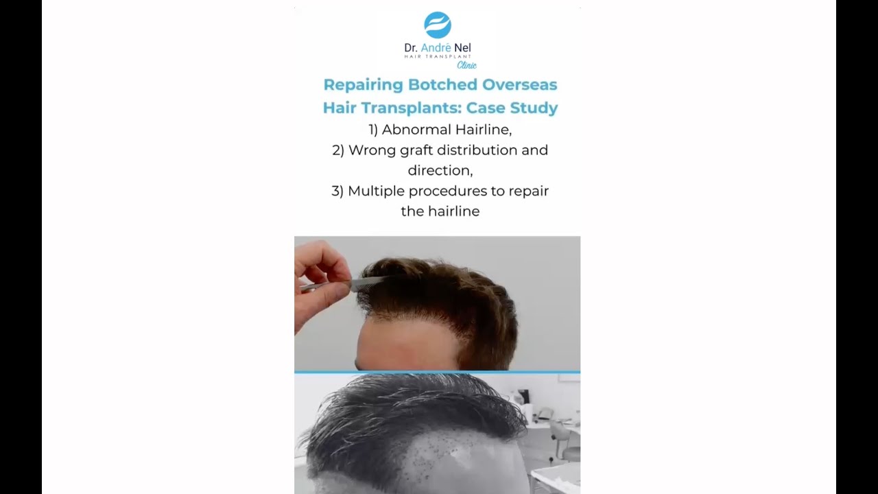 Repairing Botched Overseas Hair Transplants: Case Study