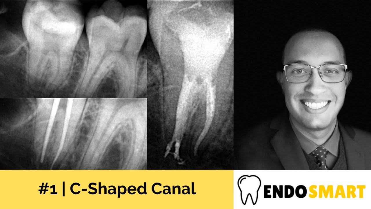 C-Shaped Canal | Canal em C | videoaula de Endodontia EndoSmart