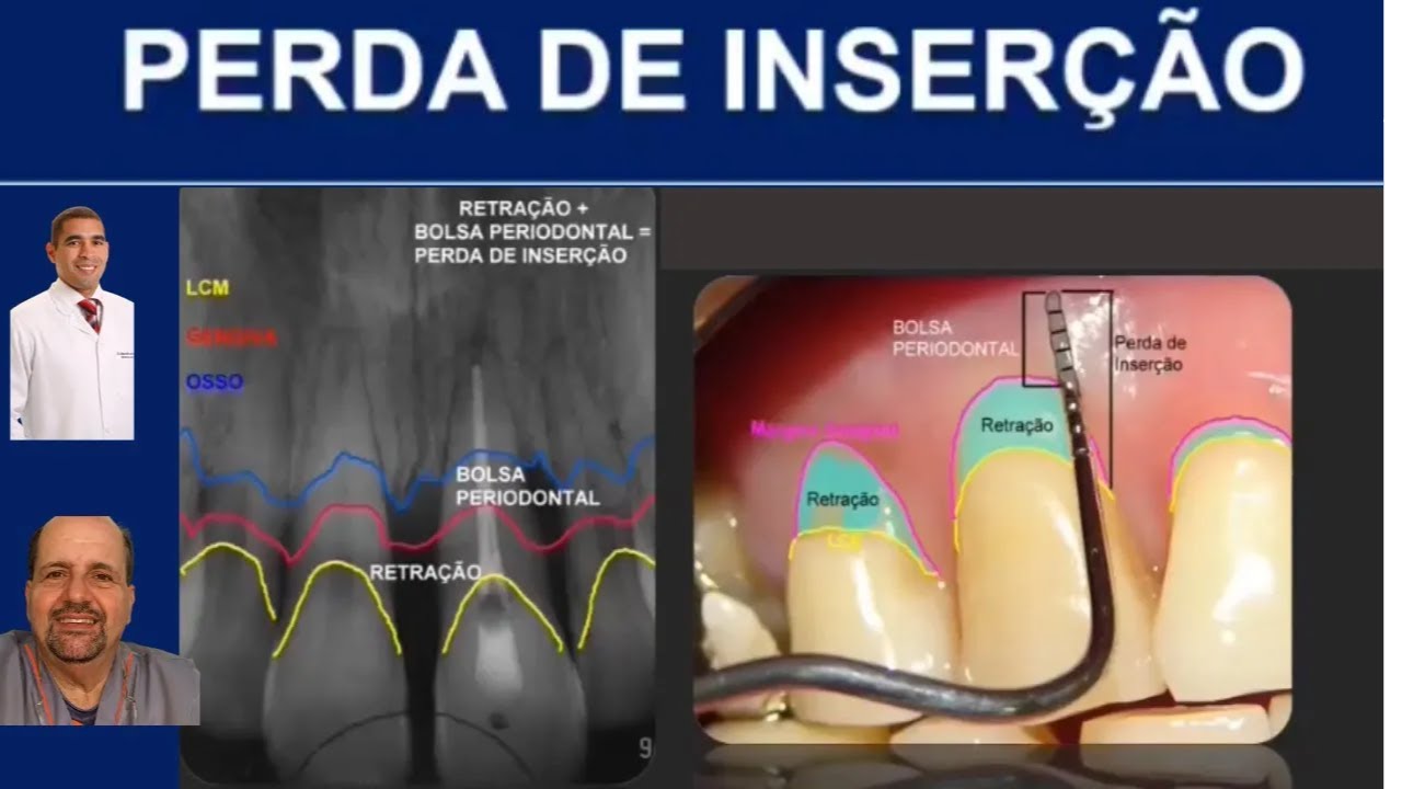 PERDA DE INSER&Ccedil;&Atilde;O. @dr.alexguedes