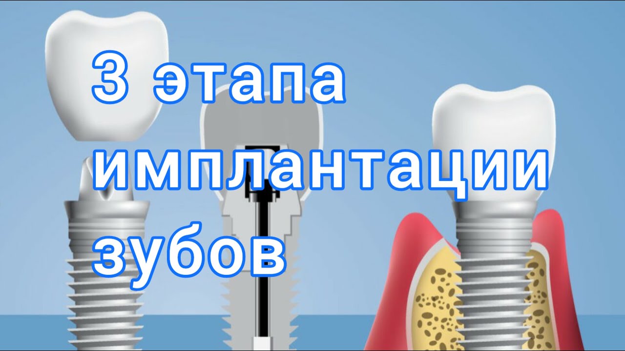 Что входит в ИМПЛАНТАЦИЮ зуба? ЭТАПЫ имплантации зубов.