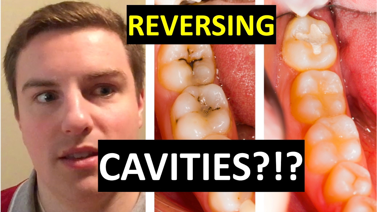 CAN YOU CURE CAVITIES AT HOME?!?
