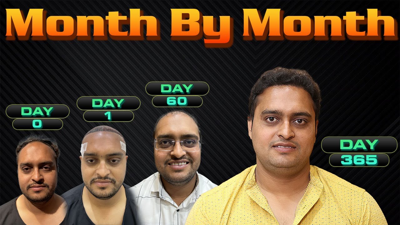 Hair Transplant Results Journey: Month by Month !!!