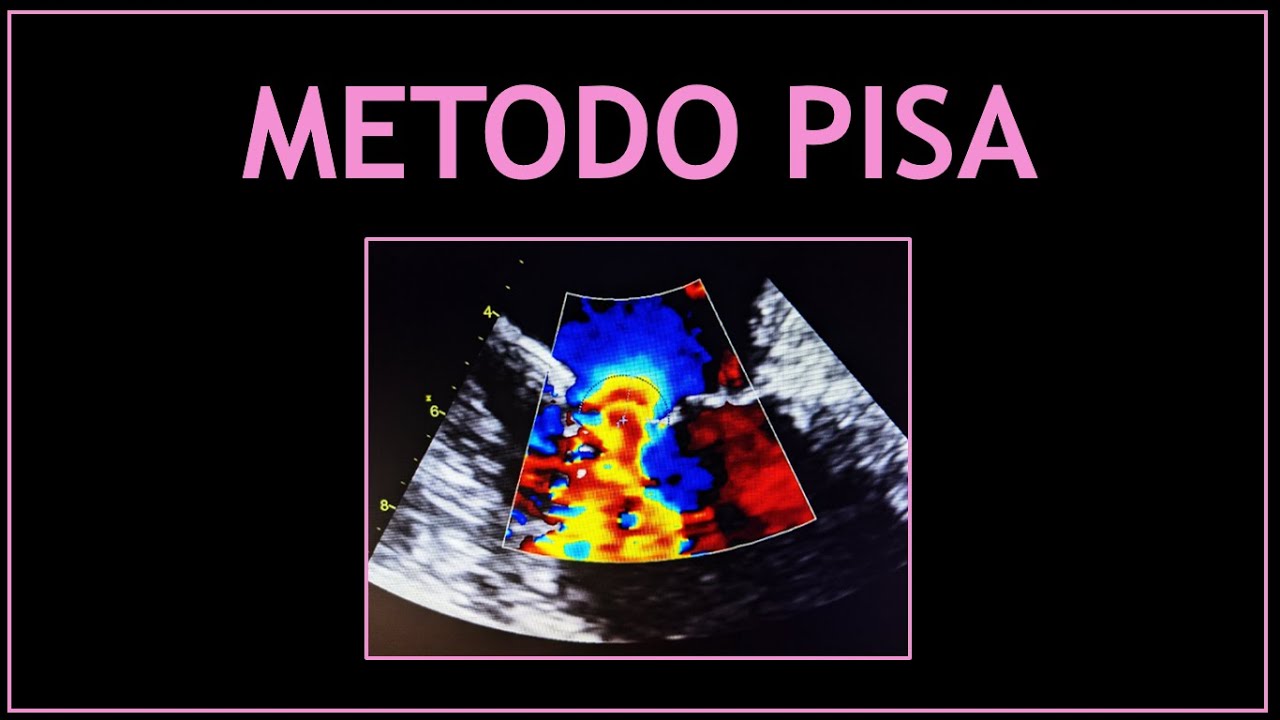 METODO PISA! (Ecocardiografia - Regurgitacion Mitral)!