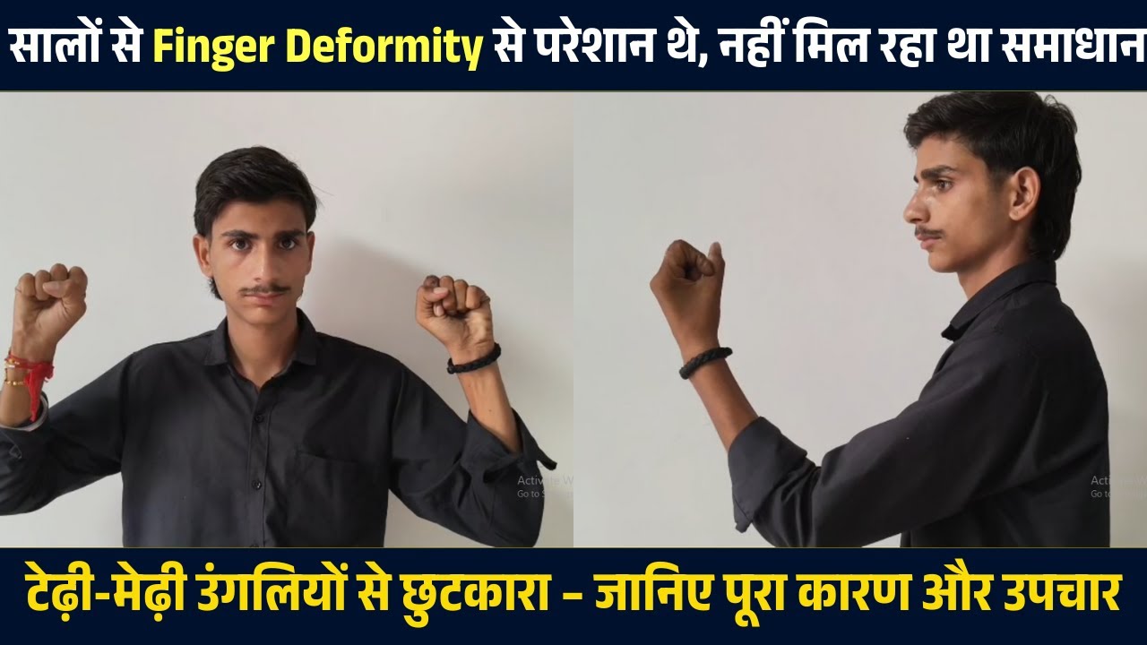 उंगली के टेढ़ेपन से परेशान? जानिए कारण और सटीक समाधान | Finger Deformity Treatment