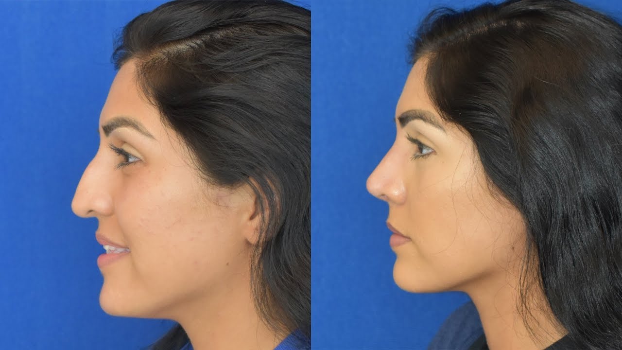 My nose looks very natural!
