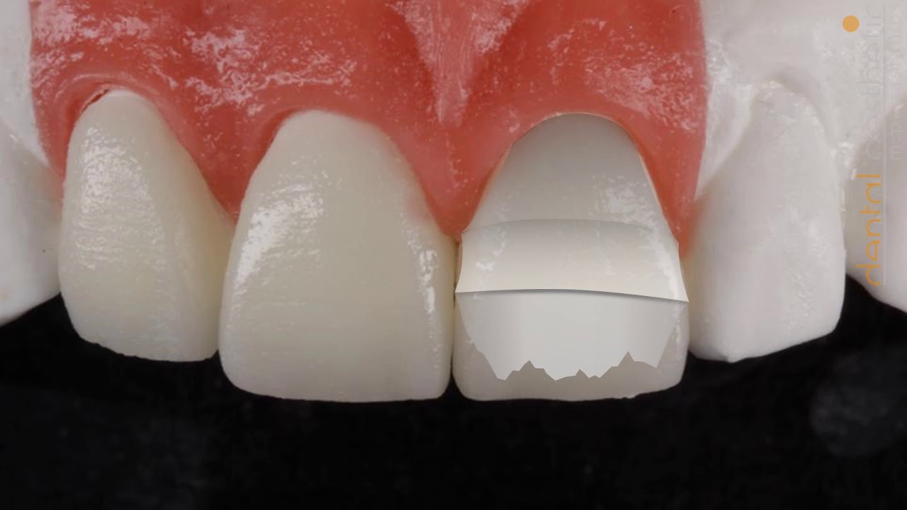 E max 4 veneers with cut back