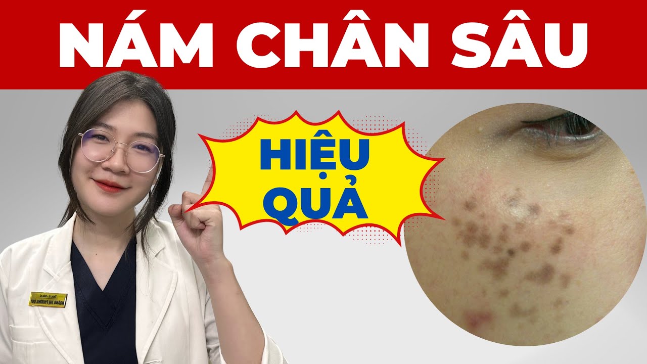 C&aacute;ch trị N&Aacute;M CH&Acirc;N S&Acirc;U hiệu quả | Thạc sĩ - B&aacute;c sĩ Phương Qu&yacute;