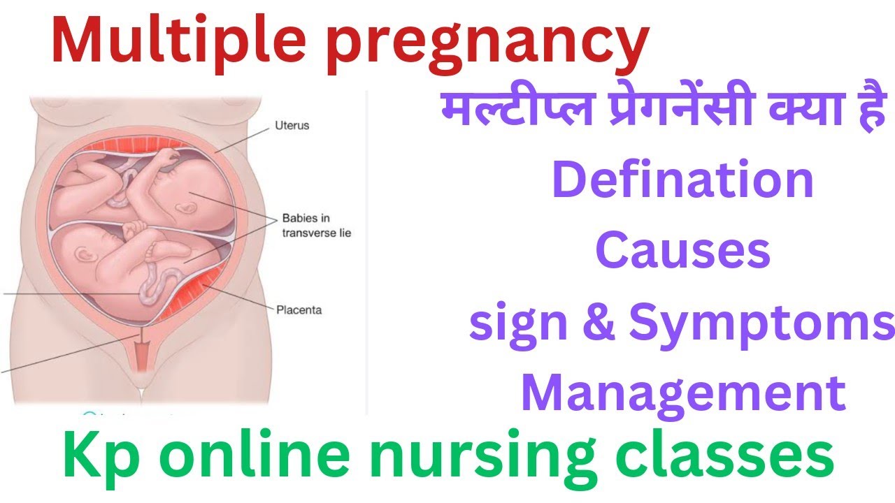 Multiple pregnancy II मल्टीप्ल प्रेगनेंसी क्या है? # ANM/ GNM # Midwifery