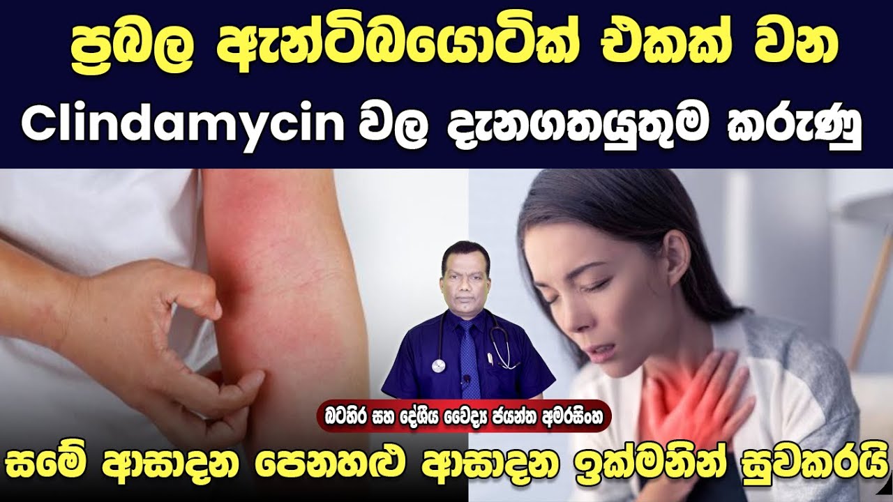 සමේ අසාදන පෙනහළු අසාදන ඇතුළු බොහෝ බැක්ටීරියා අසාදන වලට දෙන ප්‍රබල ඇන්ටිබයෝටික් එක Clindamycin