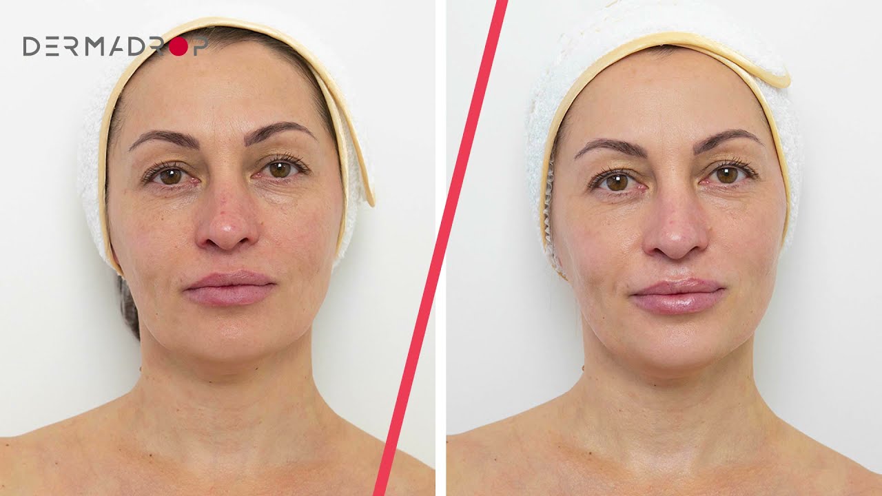 Процедура Dermadrop TDA™ в клинике Vivamedical Aesthetic Club, доктор Анна Огурцова™