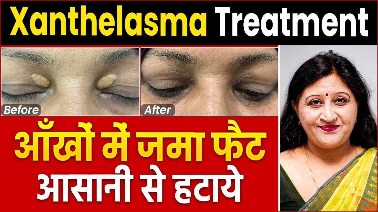 आँखों के ऊपर की चर्बी कैसे हटाएँ? | Xanthelasma का घरेलू इलाज | Dr Richa Varshney
