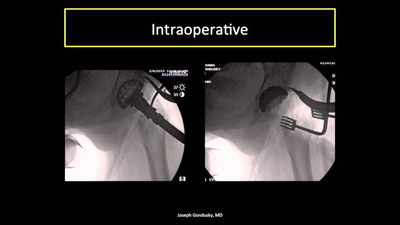 Perfecting Component Placement in Anterior Approach Total Hip Arthroplasty