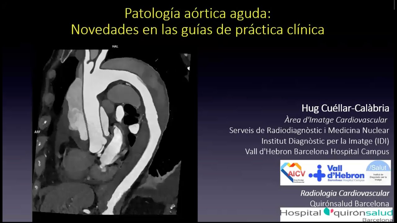 905 - Actualitzación de las guías de práctica clínica en patologia aórtica aguda.Revista Radiología.