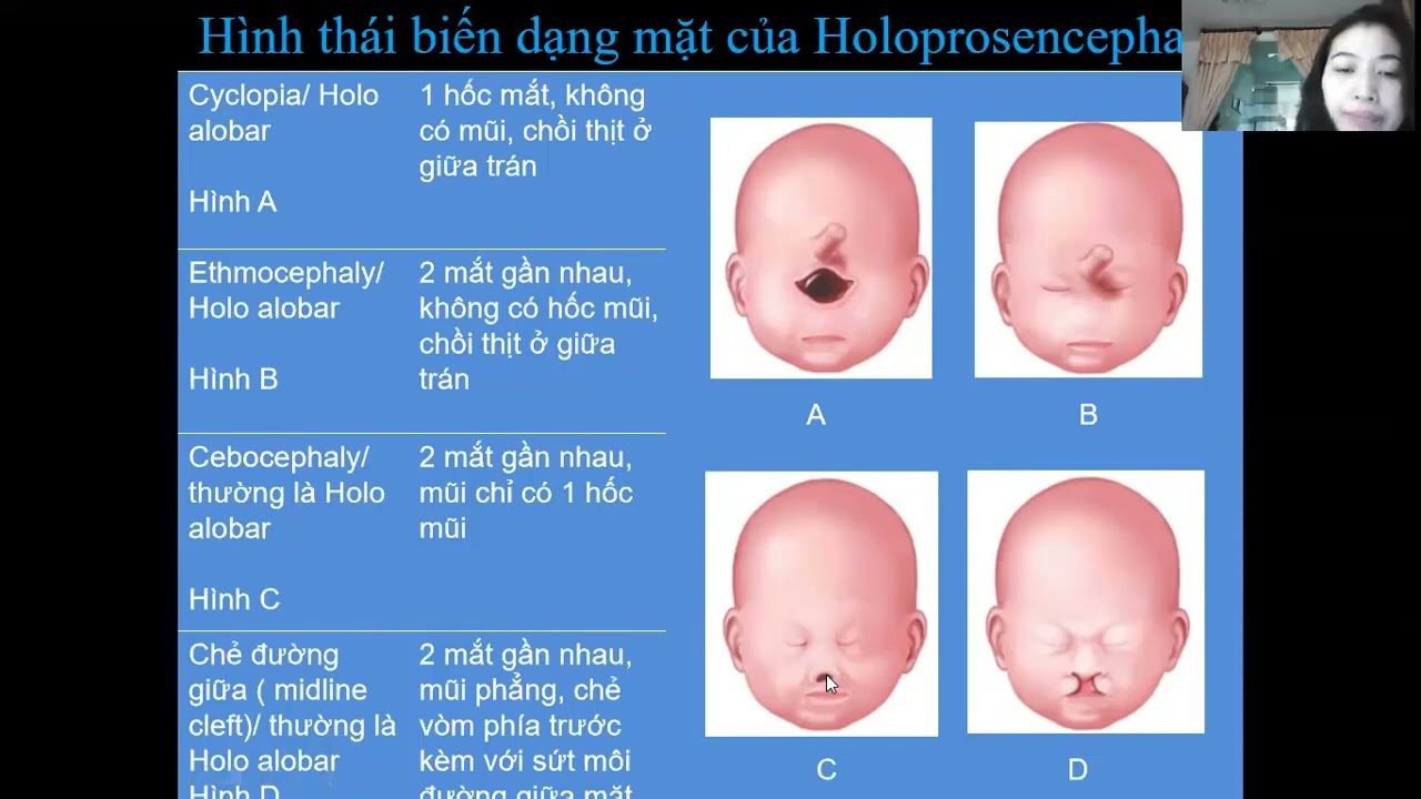 17 Siêu âm khảo sát bất thường vùng mặt thai nhi - ThS.BS. Ngô Thị Kim Loan