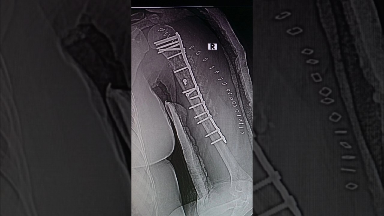 PHILOS Plate Fixation for Proximal Humerus Implant Failure #humerus #proximalhumerus #philos #ortho