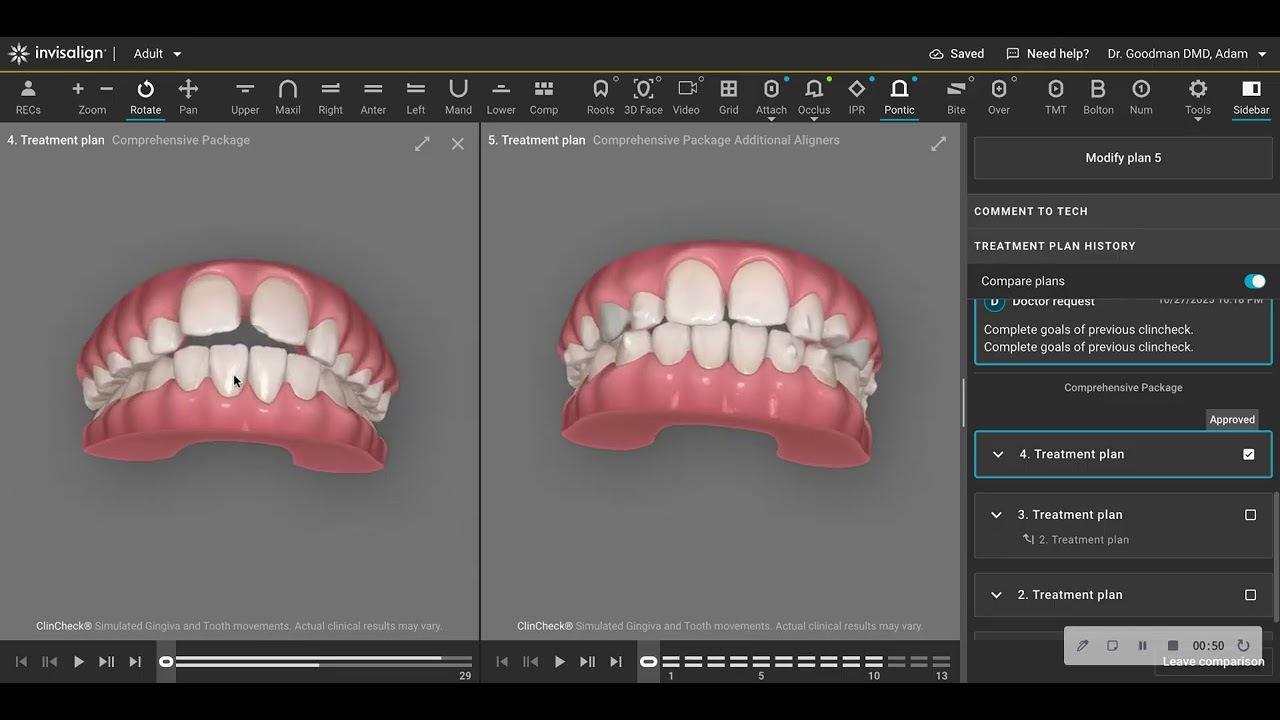 Invisalign First Incredible Result that Surpasses Fixed Palatal Expander