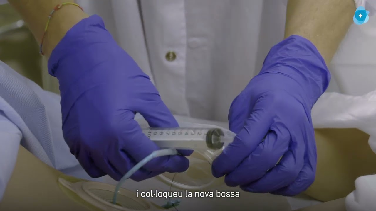 VÍDEOS DIVULGATIUS COIGI. Càpsula 2. El drenatge pigtail