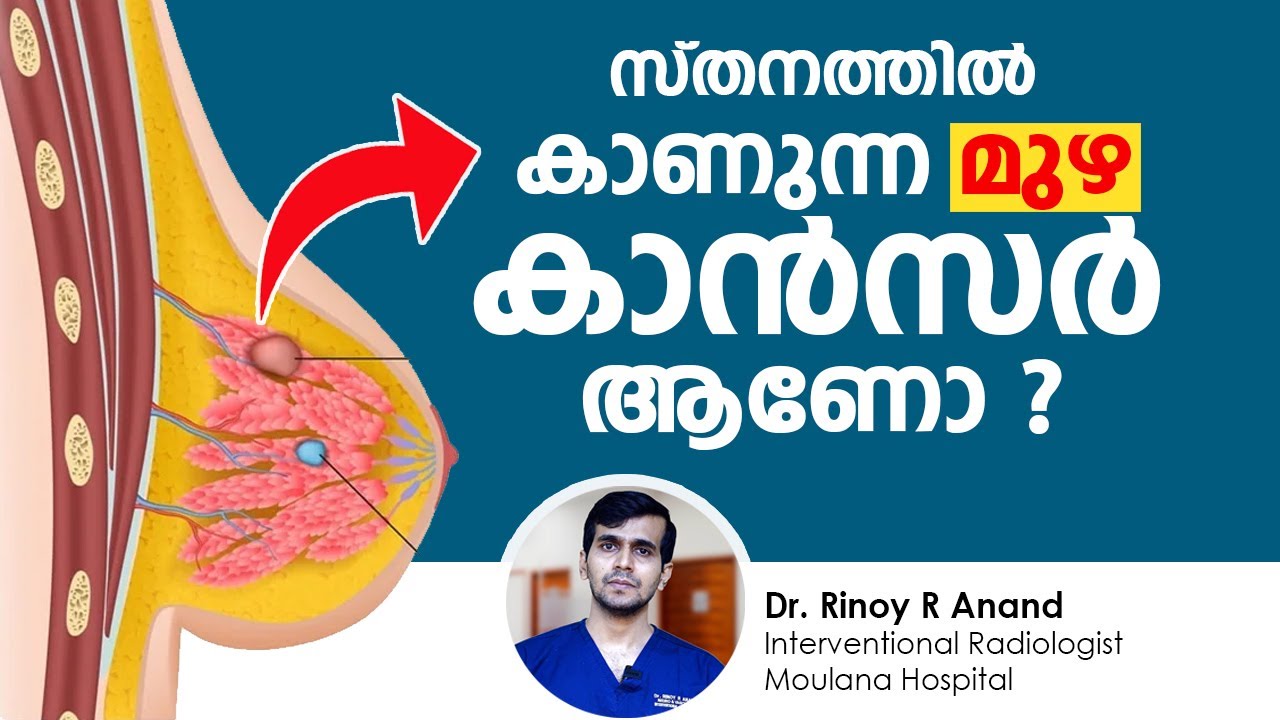 സ്തനത്തിൽ കാണുന്ന മുഴ കാൻസർ ആണോ ? Fibroadenoma Malayalam | Cancer