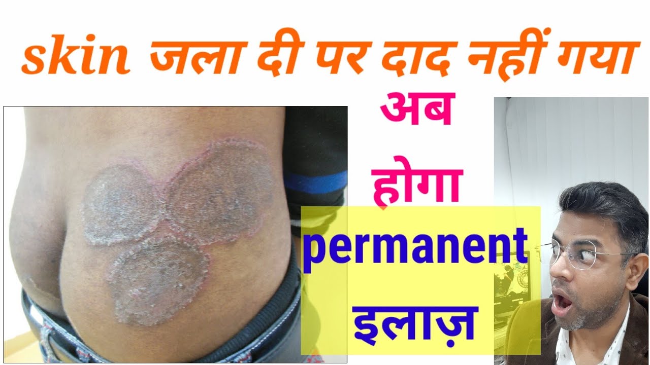 Fungal infection permanent treatment I Daad ka ilaj l Skin Care Clinic l Dr. ANIL MOHITE l MD