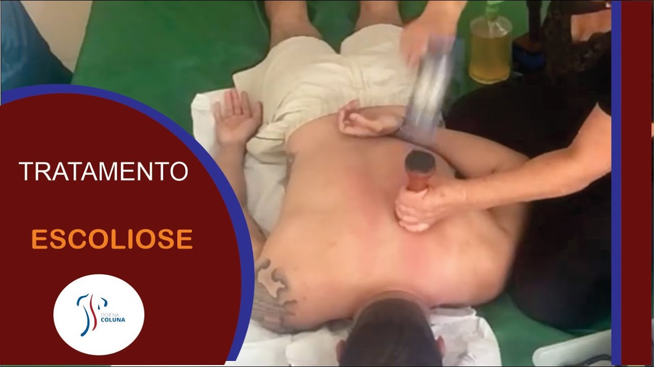 DOR NA COLUNA - Escoliose