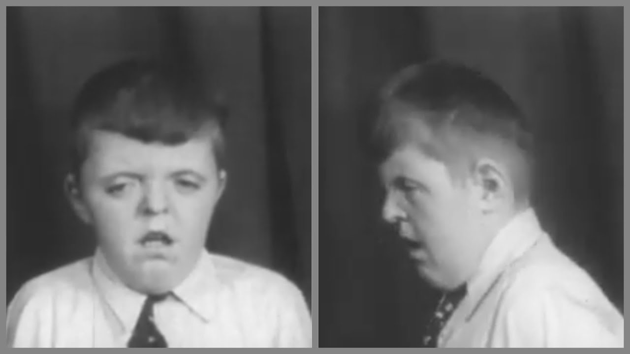 Hypertelorism and Oxycephaly. 1950s medical documentary on 