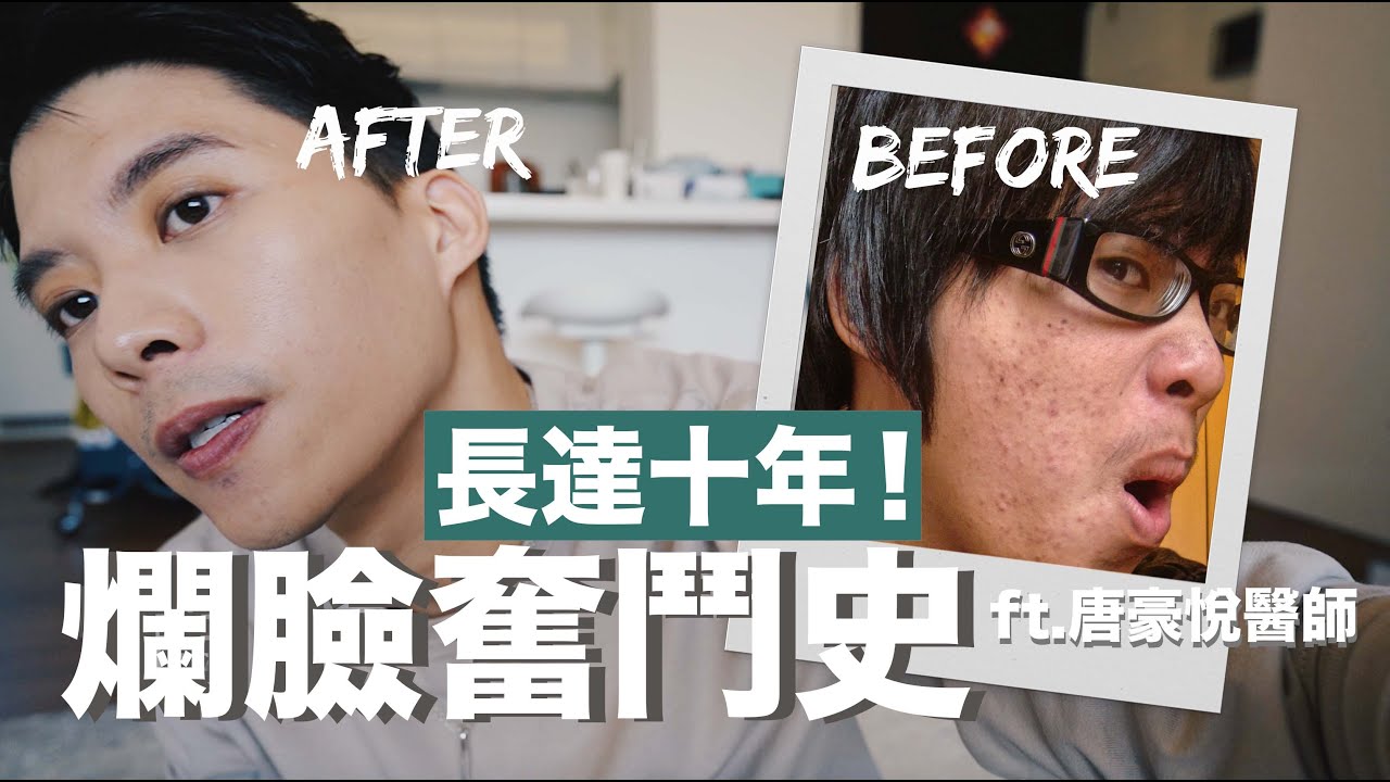 我的十年爛臉奮鬥史！皮膚科醫師大哉問 ft.唐豪悅醫師