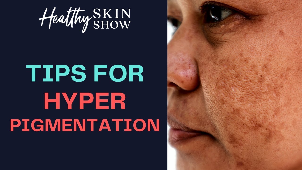 How To Deal With HYPERPIGMENTATION | Dr. Anthony Youn