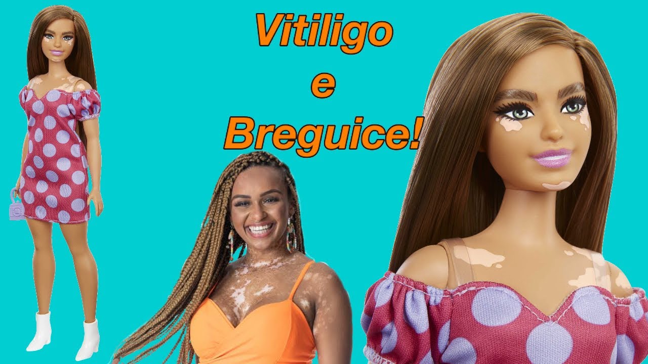 VITILIGO E BREGUICE | Review Barbie Fashionistas 171