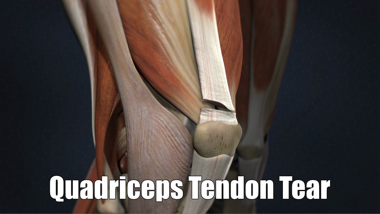 Quadriceps Tendon Tear