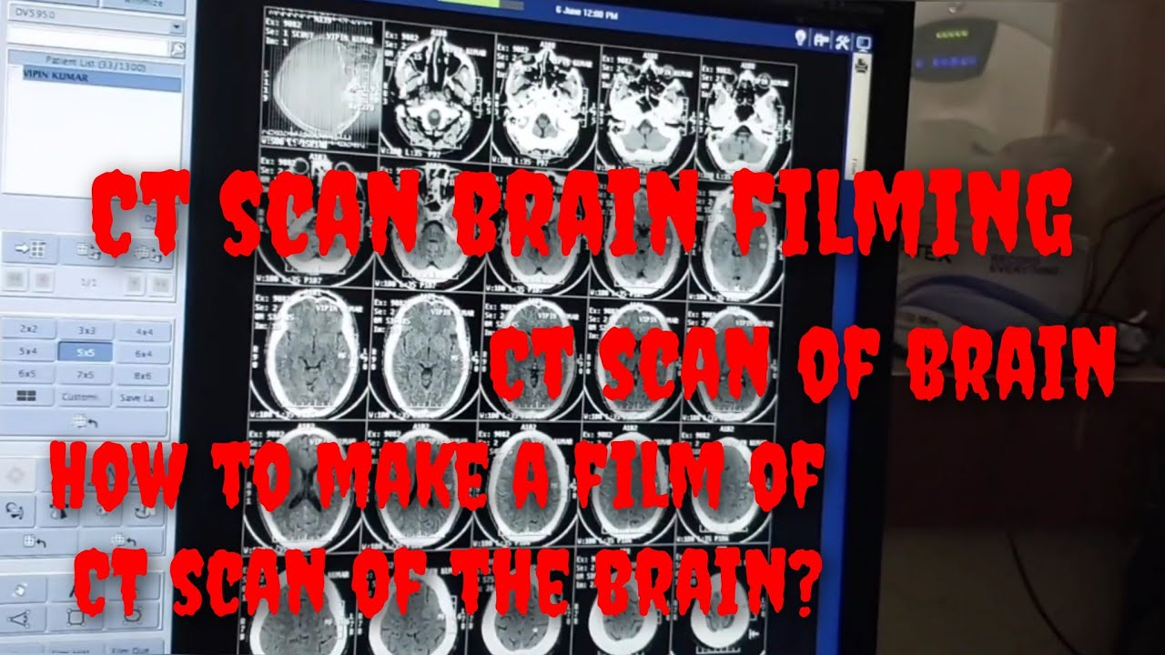 CT scan of brain filming / plating || CT scan of brain scanning || CT scan film || Brain CT scan