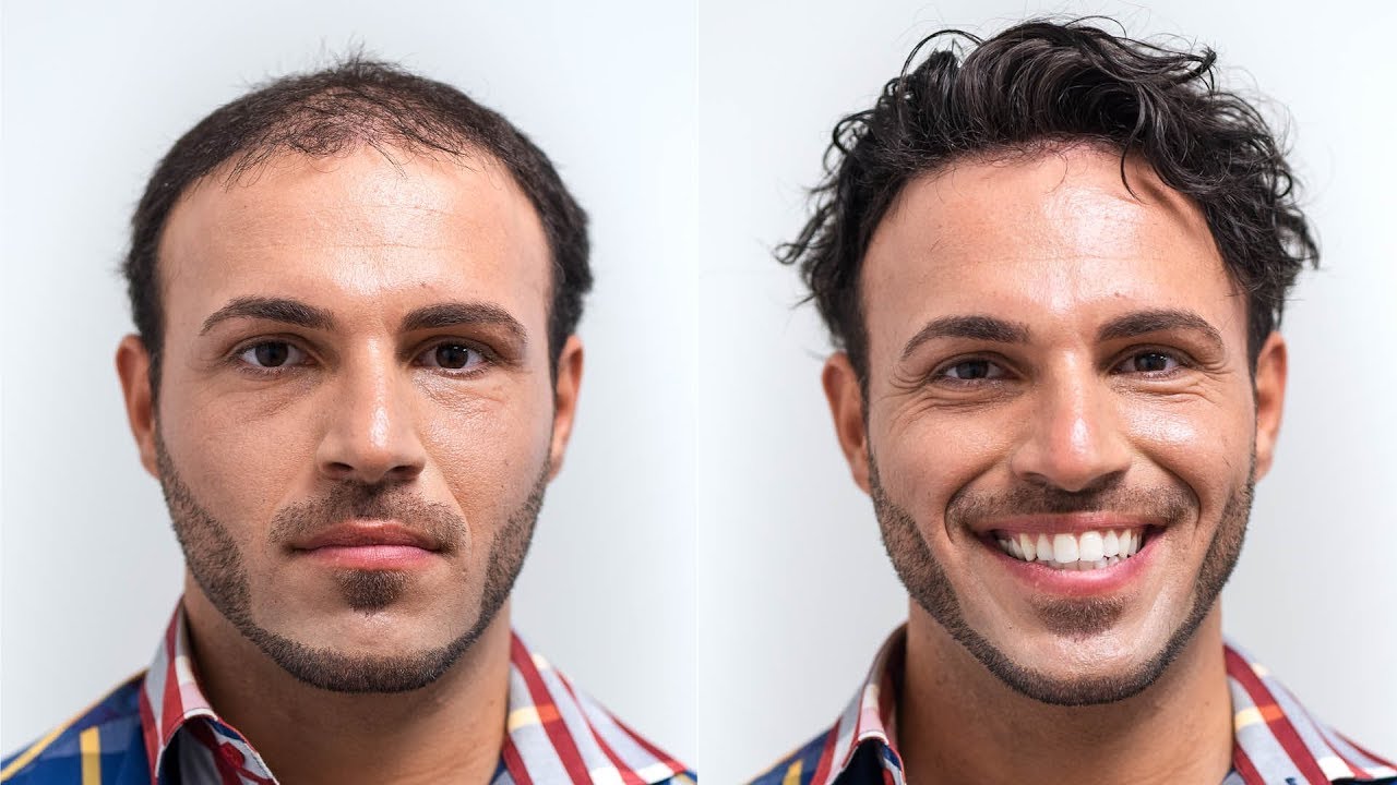 Beach Look after Hair Graft | Transformation with Hairsystem | Hairsystems Heydecke