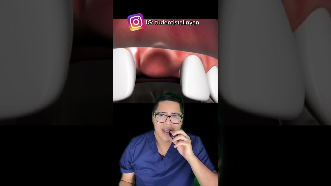MuelinFlash #28: Principales causas de la P&Eacute;RDIDA DE HUESO DENTAL 😢🦷🎤🧑🏻&zwj;⚕️