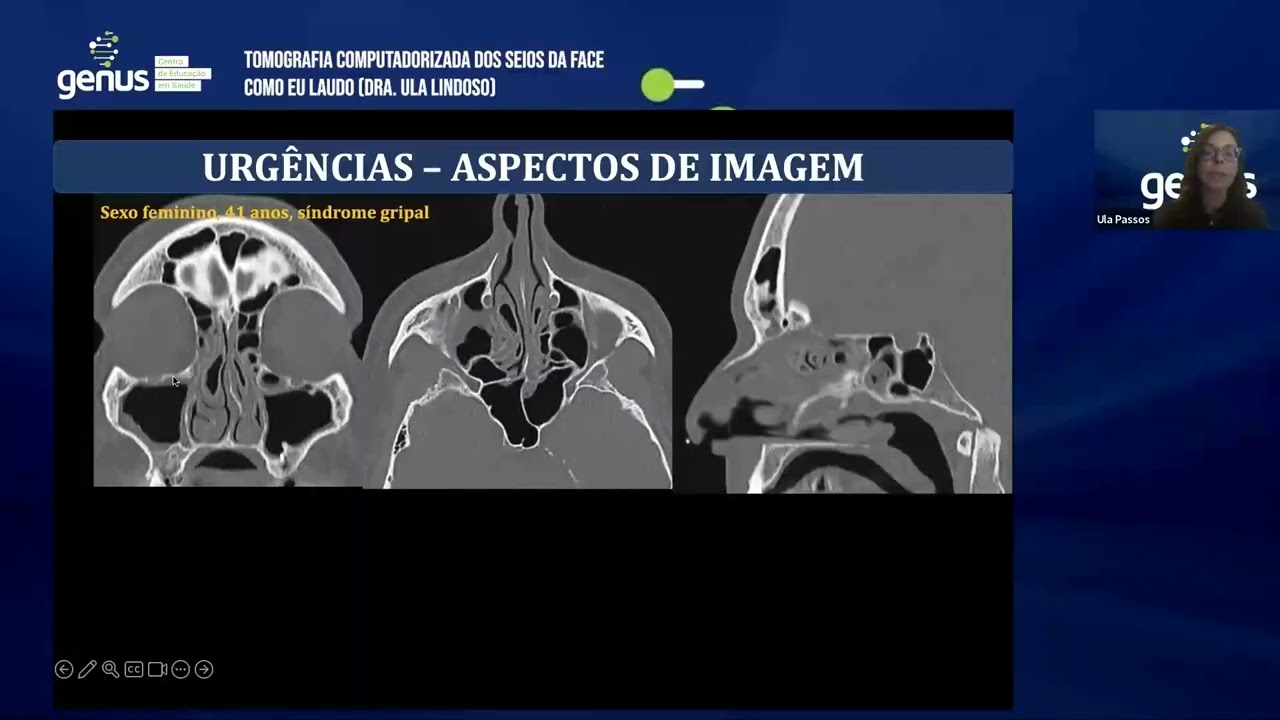 WEBINAR: TOMOGRAFIA  COMPUTADORIZADA DOS SEIOS DA FACE - COMO EU LAUDO.