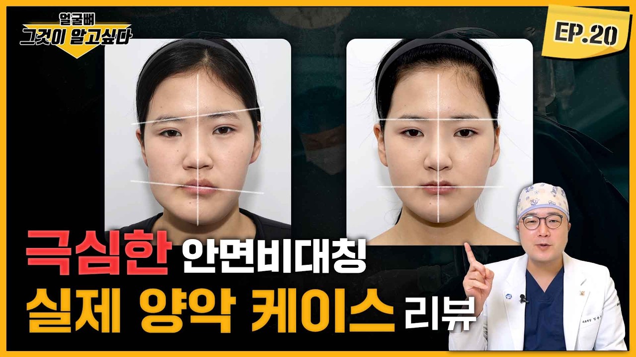 극심한 안면비대칭, 실제 양악 케이스 리뷰👨‍⚕️｜얼굴뼈그알｜임종우 원장