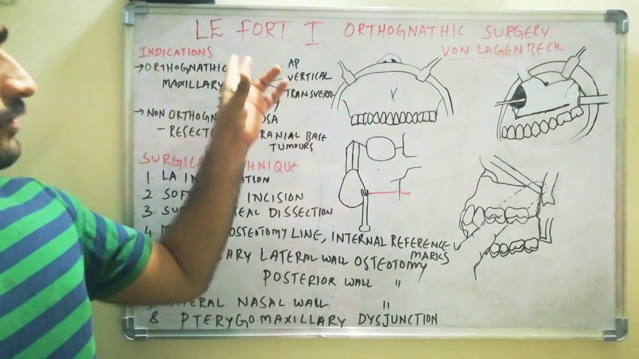 Le fort - I  osteotomy