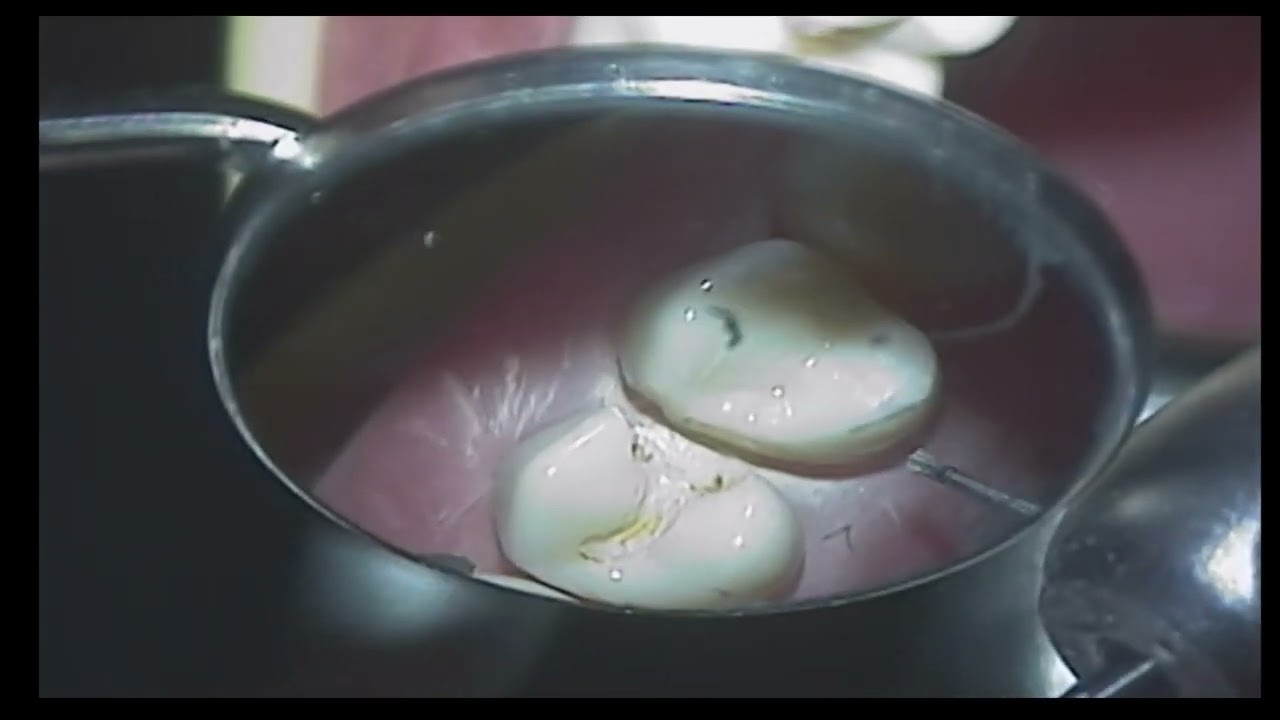 Dental Class II - modifying student preparations