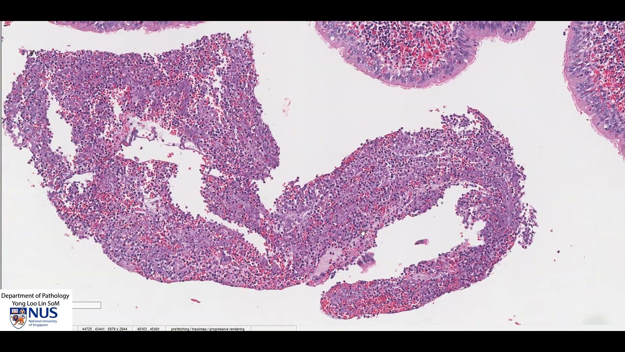Lung: Bronchiectasis Microscopy - Talking slide