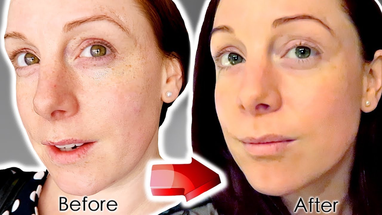 NON SURGICAL FACELIFT - CACI FACIAL, LIP & PEEL | IS IT WORTH IT?