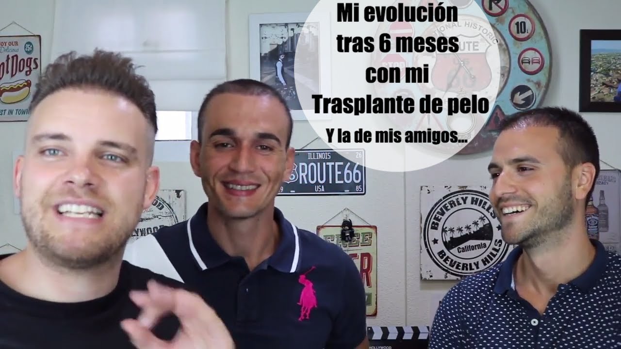 Vlog 5 Mi evolución tras 6 meses del trasplante de pelo... y la de mis AMIGOS