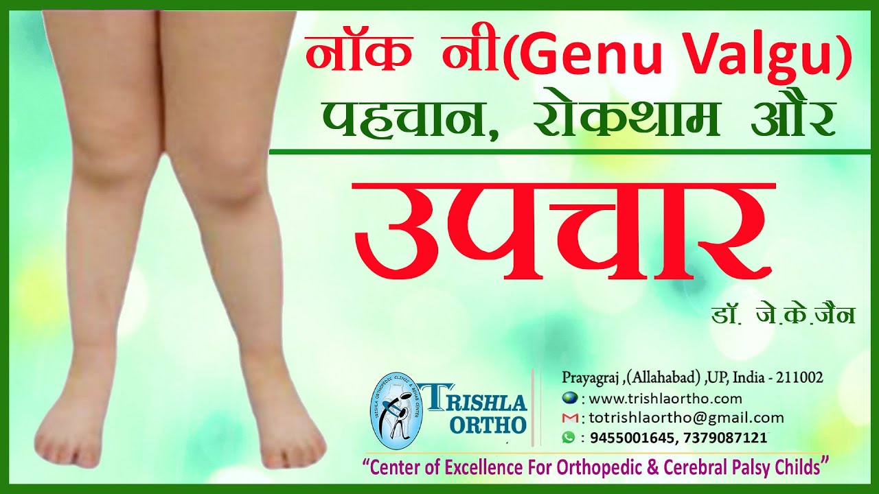 Knock knee (genu valgus): identification, prevention & treatment नॉक नी पहचान, रोकथाम और उपचार