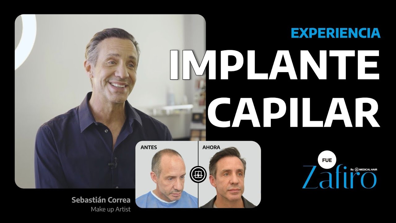 Mi implante capilar en Medical Hair - Sebasti&aacute;n Correa (Antes y despu&eacute;s)