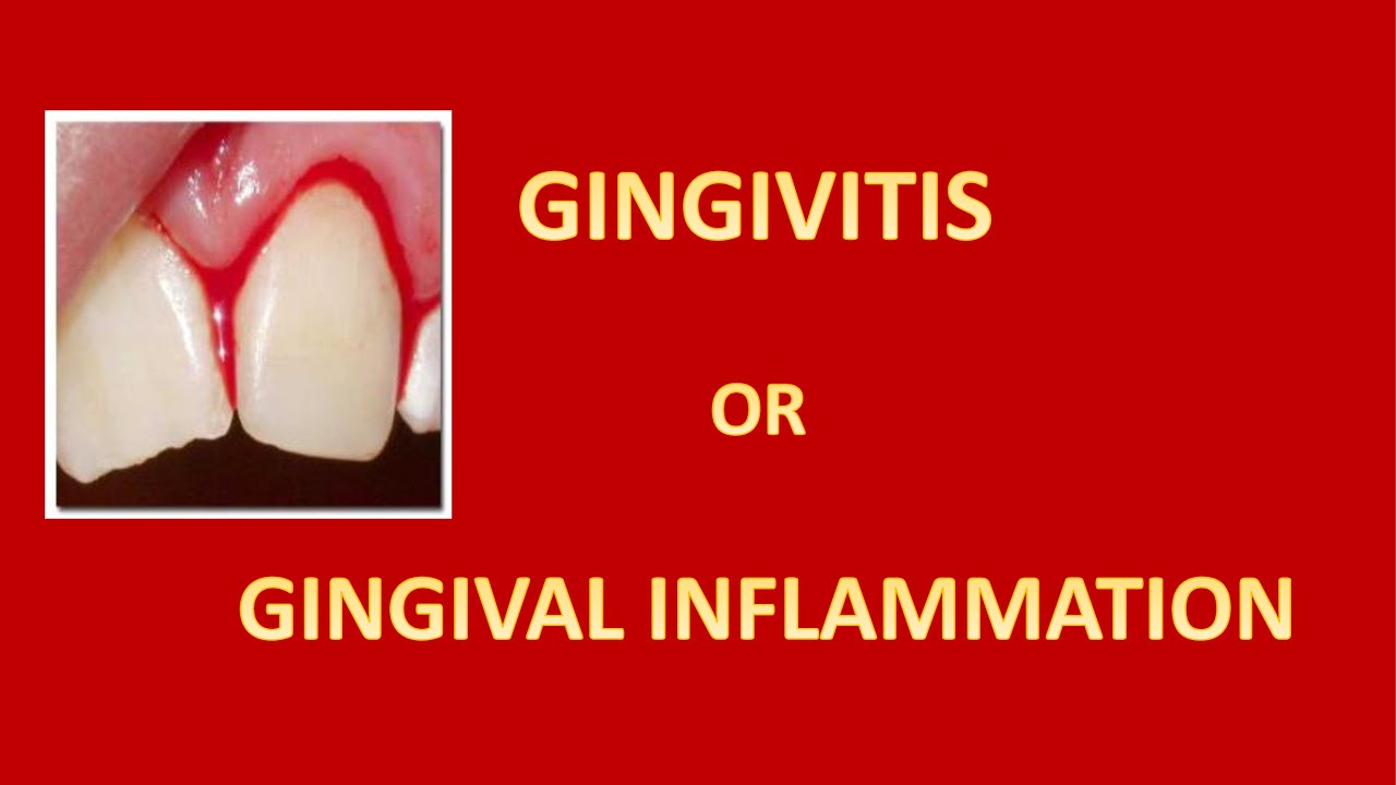 STAGES OF GINGIVITIS OR GINGIVAL INFLAMMATION