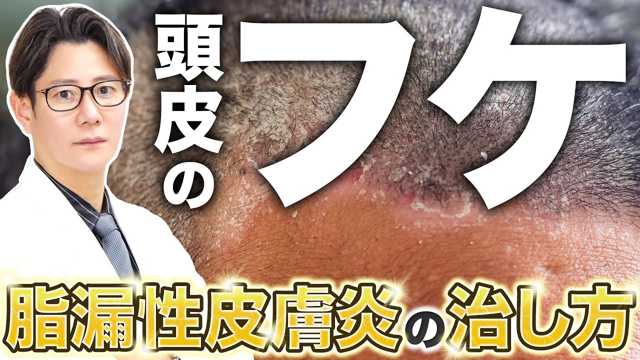 頭のフケやかゆみは脂漏性皮膚炎かも｜原因や治し方を現役皮膚科医が徹底解説
